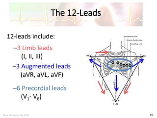 Marc Imhotep Cray, M.D.
The 12-Leads
89
12-leads include:
–3 Limb leads
(I, II, III)
–3 Augmented leads
(aVR, aVL, aVF)
–6 Precordial leads
(V1- V6)
 