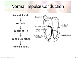 Marc Imhotep Cray, M.D.
Normal Impulse Conduction
9
Sinoatrial node
AV node
Bundle of His
Bundle Branches
Purkinje fibers
 