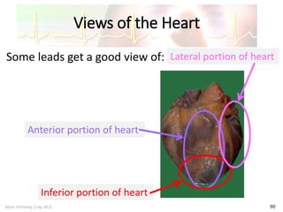 Marc Imhotep Cray, M.D.
Views of the Heart
90
Some leads get a good view of:
Anterior portion of heart
Lateral portion of heart
Inferior portion of heart
 