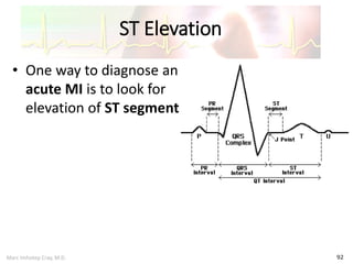 Marc Imhotep Cray, M.D.
ST Elevation
92
• One way to diagnose an
acute MI is to look for
elevation of ST segment
 