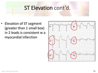 Marc Imhotep Cray, M.D.
ST Elevation cont’d.
93
• Elevation of ST segment
(greater than 1 small box)
in 2 leads is consistent w a
myocardial infarction
 