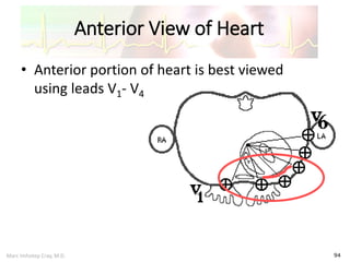 Marc Imhotep Cray, M.D.
Anterior View of Heart
94
• Anterior portion of heart is best viewed
using leads V1- V4
 