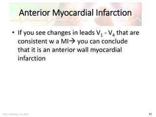 Marc Imhotep Cray, M.D.
Anterior Myocardial Infarction
95
• If you see changes in leads V1 - V4 that are
consistent w a MI you can conclude
that it is an anterior wall myocardial
infarction
 