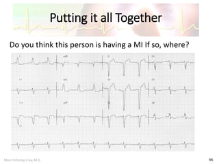 Marc Imhotep Cray, M.D.
Putting it all Together
96
Do you think this person is having a MI If so, where?
 