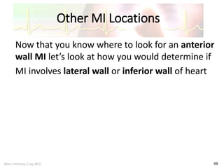 Marc Imhotep Cray, M.D.
Other MI Locations
98
Now that you know where to look for an anterior
wall MI let’s look at how you would determine if
MI involves lateral wall or inferior wall of heart
 
