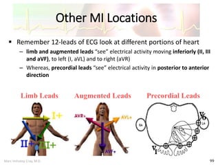 Marc Imhotep Cray, M.D.
Other MI Locations
99
 Remember 12-leads of ECG look at different portions of heart
– limb and augmented leads “see” electrical activity moving inferiorly (II, III
and aVF), to left (I, aVL) and to right (aVR)
– Whereas, precordial leads “see” electrical activity in posterior to anterior
direction
Limb Leads Augmented Leads Precordial Leads
 