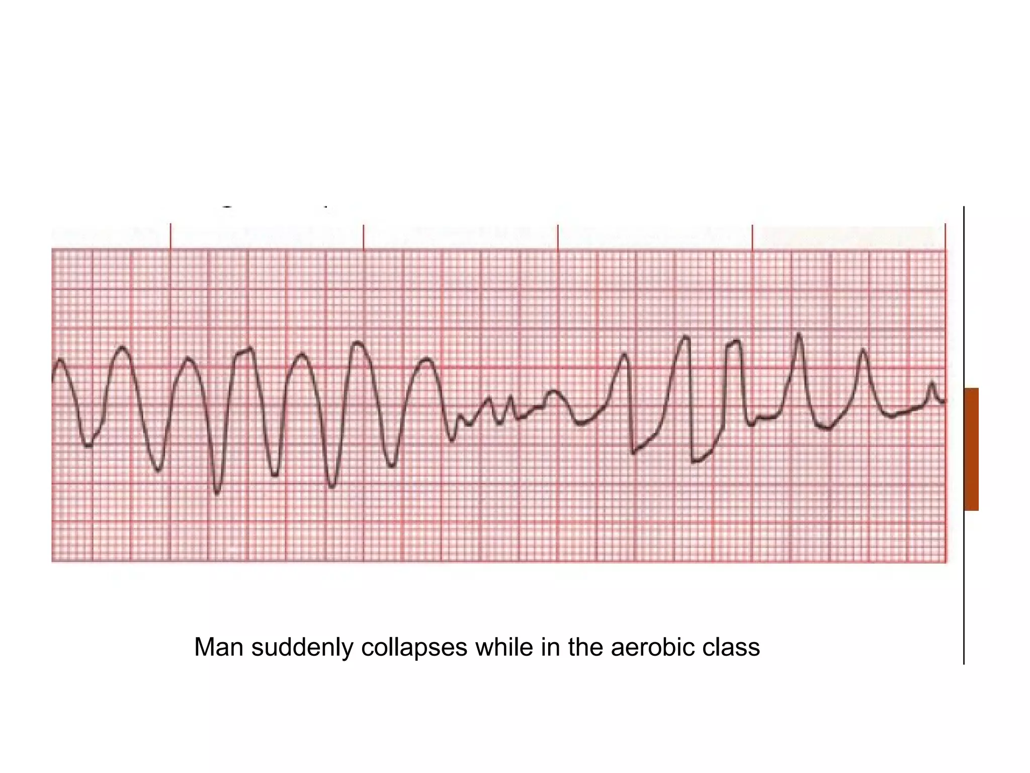 Ecg Interpritation (2) | PPT