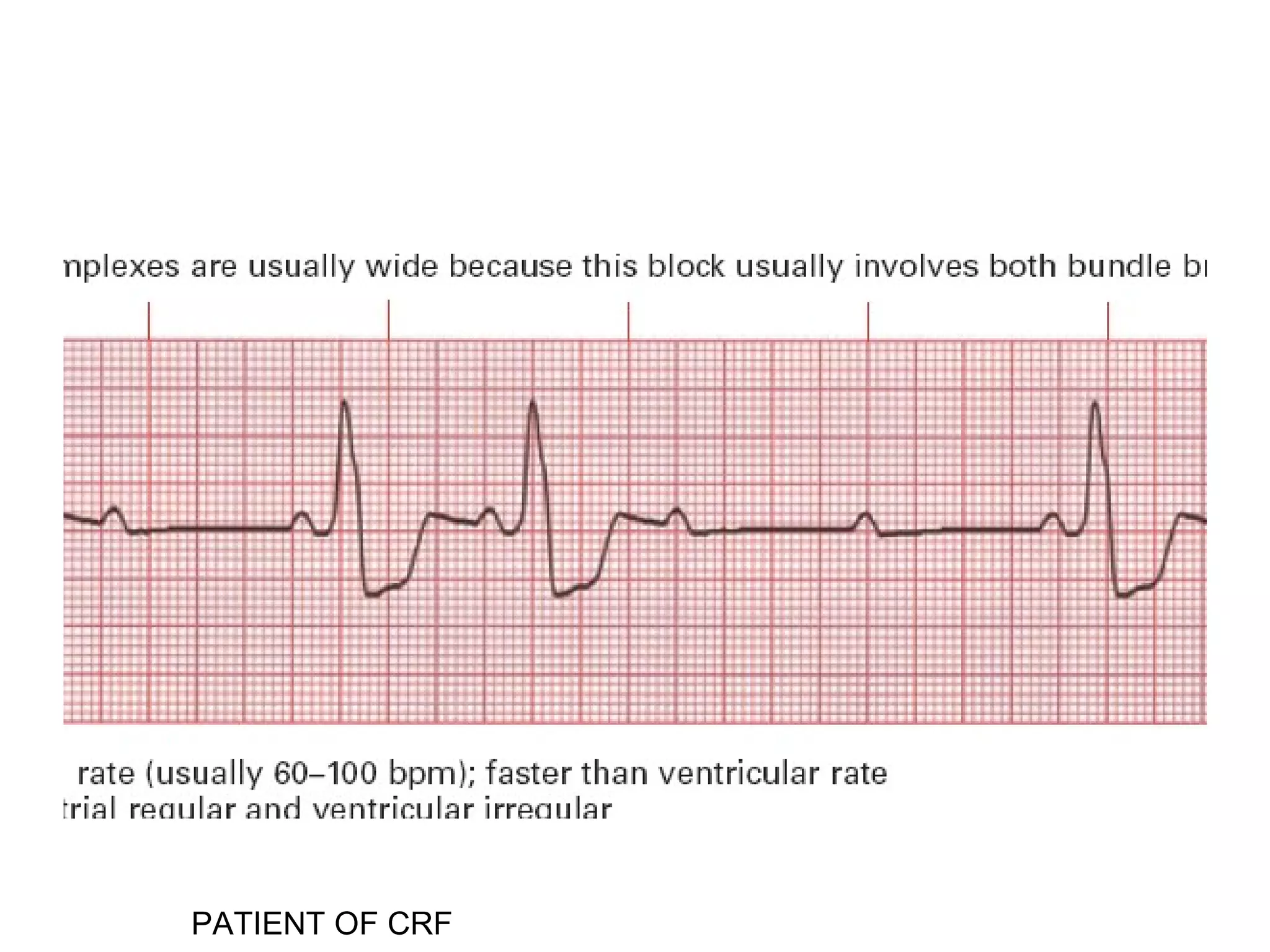 Ecg Interpritation (2) | PPT