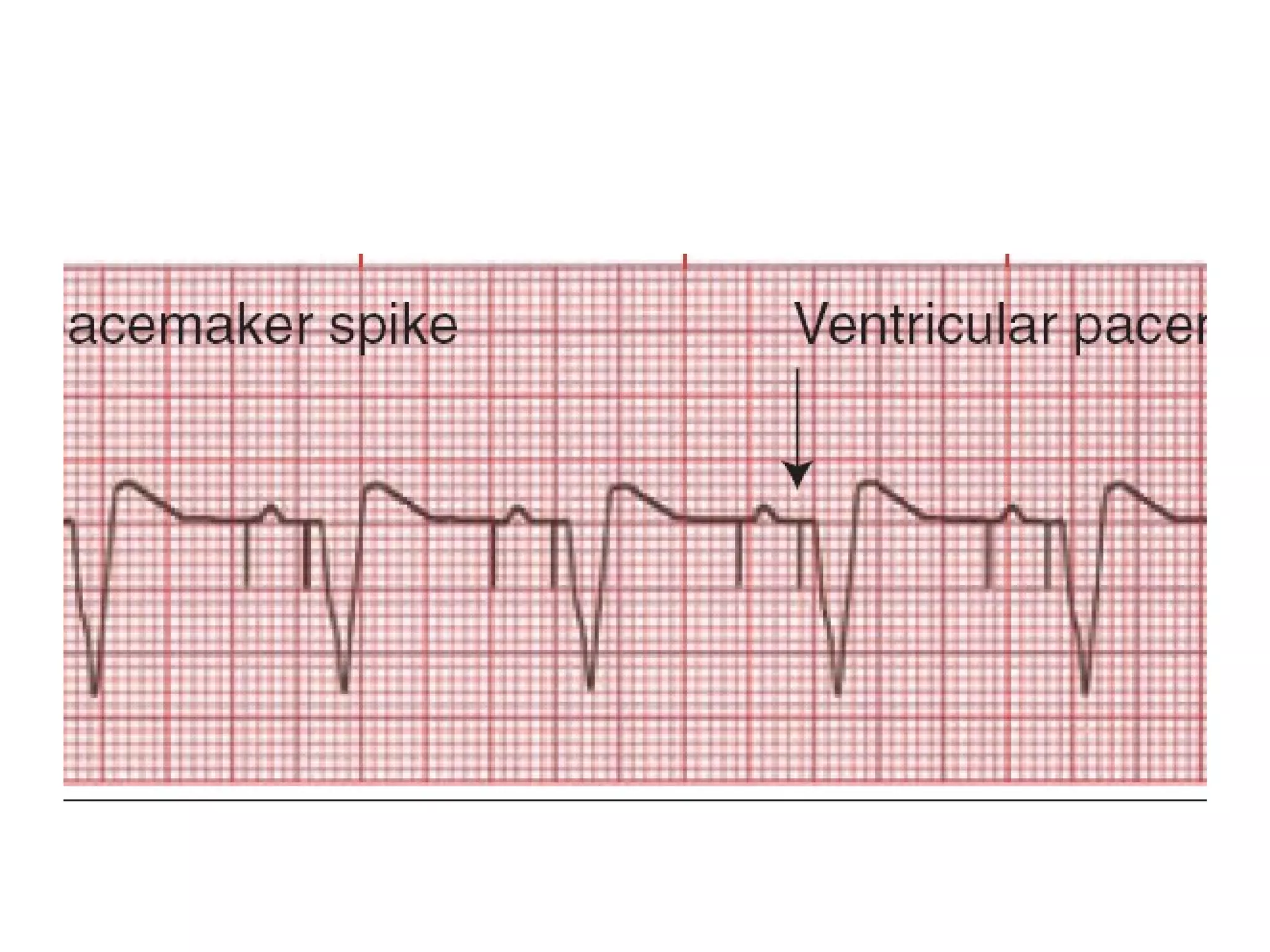 Ecg Interpritation (2) | PPT