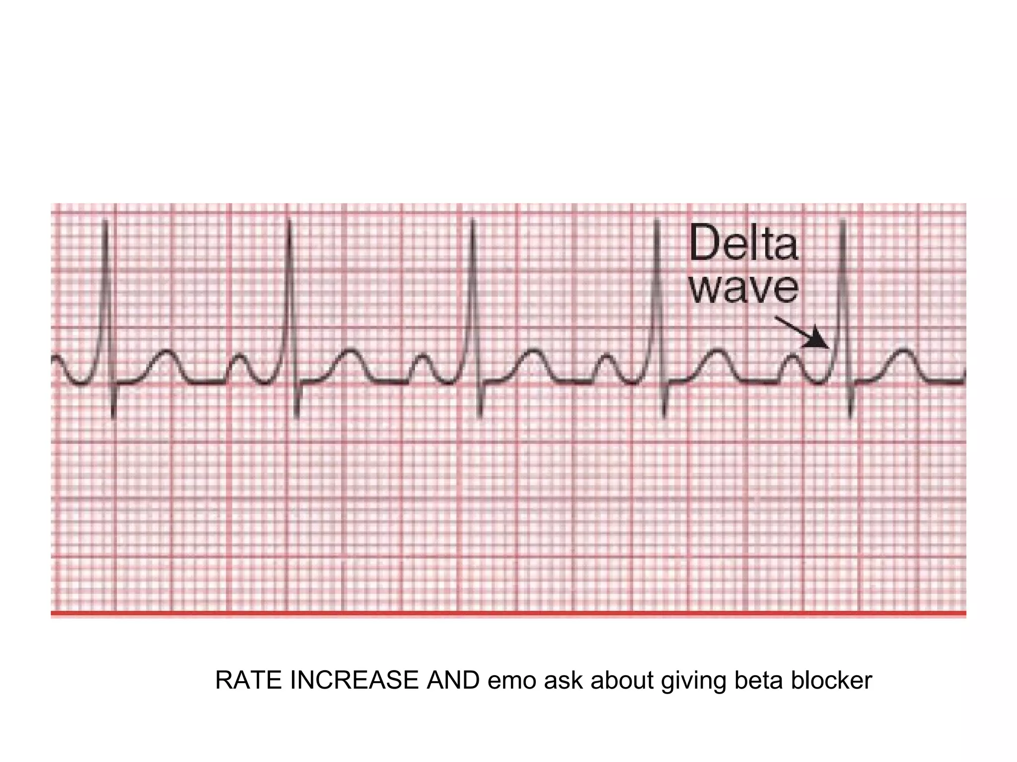 Ecg Interpritation (2) | PPT