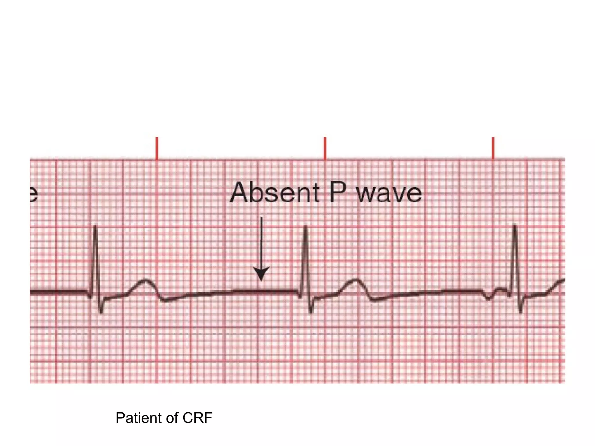 Ecg Interpritation (2) | PPT