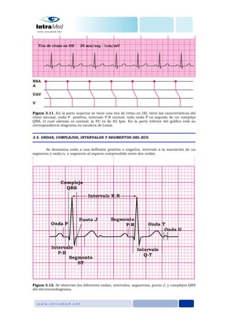 Figura 3.11. En la parte superior se tiene una tira de ritmo en DII, tiene las características del
ritmo sinusal, onda P positiva, intervalo P-R normal, toda onda P va seguida de un complejo
QRS, el cual además es normal; la FC es de 82 lpm. En la parte inferior del gráfico está su
correspondiente diagrama en escalera de Lewis.
3.5. ONDAS, COMPLEJOS, INTERVALOS Y SEGMENTOS DEL ECG
Se denomina onda a una deflexión positiva o negativa, intervalo a la asociación de un
segmento y onda/s, y segmento al espacio comprendido entre dos ondas.
Figura 3.12. Se observan las diferentes ondas, intervalos, segmentos, punto J, y complejos QRS
del electrocardiograma.
 