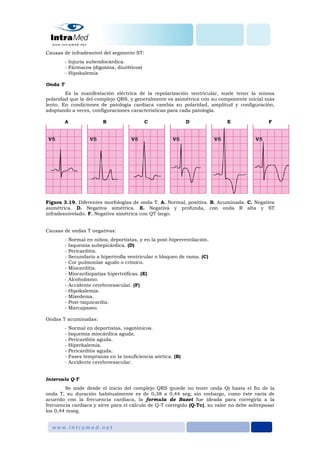 Causas de infradesnivel del segmento ST:
- Injuria subendocárdica.
- Fármacos (digoxina, diuréticos)
- Hipokalemia
Onda T
Es la manifestación eléctrica de la repolarización ventricular, suele tener la misma
polaridad que la del complejo QRS, y generalmente es asimétrica con su componente inicial más
lento. En condiciones de patología cardiaca cambia su polaridad, amplitud y configuración,
adoptando a veces, configuraciones características para cada patología.
A B C D E F
Figura 3.19. Diferentes morfologías de onda T. A. Normal, positiva. B. Acuminada. C. Negativa
asimétrica. D. Negativa simétrica. E. Negativa y profunda, con onda R alta y ST
infradesnivelado. F. Negativa simétrica con QT largo.
Causas de ondas T negativas:
- Normal en niños, deportistas, y en la post-hiperventilación.
- Isquemia subepicárdica. (D)
- Pericarditis.
- Secundario a hipertrofia ventricular o bloqueo de rama. (C)
- Cor pulmonlae agudo o crónico.
- Miocarditis.
- Miocardiopatías hipertróficas. (E)
- Alcoholismo.
- Accidente cerebrovascular. (F)
- Hipokalemia.
- Mixedema.
- Post-taquicardia.
- Marcapaseo.
Ondas T acuminadas:
- Normal en deportistas, vagotónicos.
- Isquemia miocárdica aguda.
- Pericarditis aguda.
- Hiperkalemia.
- Pericarditis aguda.
- Fases tempranas en la insuficiencia aórtica. (B)
- Accidente cerebrovascular.
Intervalo Q-T
Se mide desde el inicio del complejo QRS (puede no tener onda Q) hasta el fin de la
onda T, su duración habitualmente es de 0,38 a 0,44 seg; sin embargo, como éste varía de
acuerdo con la frecuencia cardiaca, la formula de Bazet fue ideada para corregirla a la
frecuencia cardiaca y sirve para el cálculo de Q-T corregido (Q-Tc), su valor no debe sobrepasar
los 0,44 mseg.
 