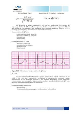 En la fórmula de Shipley y Hallaran; K = 0,397 para los varones, y 0,415 para las
mujeres, y el intervalo R-R se mide en segundos; el valor normal no debe superar el 10% del
valor medido de esta manera. A una misma FC el QTc obtenido durante el sueño es 10-15%
más largo que en vigilia, y se debería a una mayor influencia vagal.
Causas de intervalo QT largo:
- Síndrome de QT largo adquirido
- Síndrome de QT largo congénito
- Hipokalemia
- Hipocalcemia
Causas de intervalo QT corto
- Síndrome de QT corto
- Intoxicación con digoxina
- Hipercalcemia
- Hiperkalemia
Figura 3.20. Diferentes morfologías de intervalo QT largo.
Onda U
Es una deflexión de baja frecuencia, aparece después de la onda T, y tiende a no ser
visible a FC >85 lpm. Posiblemente corresponda a repolarización ventricular tardía,
repolarización de los músculos papilares o del sistema His-Purkinje cuyos potenciales
transmembrana son prolongados. Algunos autores prefieren la medición del intervalo Q-U para
evaluar el tiempo total de repolarización ventricular.
Causas de ondas U prominentes:
- Hipokalemia
- Isquemia miocárdica aguda grave (en derivaciones precordiales).
 