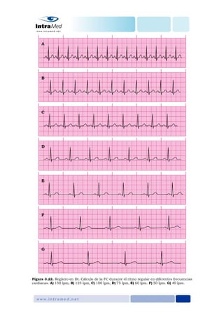 Figura 3.22. Registro en DI. Cálculo de la FC durante el ritmo regular en diferentes frecuencias
cardiacas. A) 150 lpm, B) 125 lpm, C) 100 lpm, D) 75 lpm, E) 60 lpm. F) 50 lpm. G) 40 lpm.
 