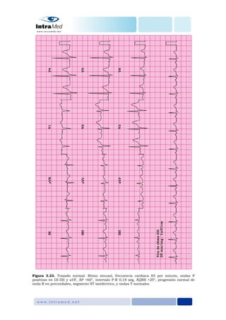 Figura 3.23. Trazado normal. Ritmo sinusal, frecuencia cardiaca 85 por minuto, ondas P
positivas en DI-DII y aVF, ÂP +60°, intervalo P-R 0,18 seg, ÂQRS +20°, progresión normal de
onda R en precordiales, segmento ST isoeléctrico, y ondas T normales.
 