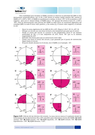 Otra modalidad para localizar el ÂQRS consiste es observar la polaridad del QRS en dos
derivaciones perpendiculares; así: si DI y aVF tienen el mismo voltaje positivo (DI, orienta el
ÂQRS a 0° y aVF a +90°), el ÂQRS es equidistante a ambos, es decir +45°; si DI es positivo y aVF
negativo, pero con el mismo voltaje, el ÂQRS está a –45° (porque DI orienta el eje a 0°, y aVF a
-90°). Para la determinación más precisa del ÂQRS se debe hacer la sumatoria algebraica del
complejo QRS; la onda R tiene valor positivo, y las ondas Q y S tienen valor negativo; el método
es así:
- Hacer la suma algebraica de los QRS de DI y aVF, (Figura 3.26.C: DI +6, aVF -8).
- Dibujar un círculo con una línea vertical y otra horizontal que pase por el centro.
- Desde el centro del círculo se cuentan 6 mm dirigiéndose hacia 0° (la máxima
positividad de DI), y 8 mm alejándose de aVF, hacia -90° que es la máxima
negatividad de aVF.
- Extender dos líneas para que se entrecrucen entre ellas.
- Trazar una línea el centro del círculo y que pasando por el punto de intersección
llegue hasta el círculo.
- El punto donde alcanza en el círculo, ese el ÂQRS; en el ejemplo: -55°.
Figura 3.27. Cálculo del eje eléctrico del corazón. La zona oscura marca el cuadrante donde los
hemicampos de las derivaciones DI y aVF coinciden para determinar el área del ÂQRS. A) ÂQRS
normal, +60°. B) ÂQRS normal, +45°. C) ÂQRS izquierdo, -55°. D) ÂQRS vertical, +90°. E) ÂQRS
hiperderecho -150°. F) ÂQRS derecho, +125°.
 