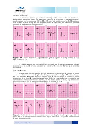 Corazón horizontal
Las situaciones clínicas que condicionan la disposición horizontal del corazón (obesos,
embarazadas a término), hacen que las fuerzas eléctricas se orienten a 0°, hacia la izquierda,
condicionando que los complejos QRS de DI y aVL sean más positivos que los de DII; en tanto
que, los QRS de aVR, aVF y DIII son negativos; dicho de otro modo, los potenciales positivos
máximos se registran en el brazo izquierdo.
Figura 3.29. Corazón horizontal. La polaridad del QRS es negativa en aVF y positiva en DI y
aVL. El ÂQRS es -20°.
La rotación sobre el eje longitudinal hace que esté uno de los ventrículos este más en
contacto con la pared torácica anterior; se describen la rotación horaria y la rotación
antihoraria.
Rotación horaria
En esta situación el ventrículo derecho ocupa más precordio que lo normal, de modo
que el plano de transición está desplazado a la izquierda; así, los complejos RS se inscriben en
V5 ó V6, las ondas S persisten hasta V6 pero sin onda q; por esto mismo se observa un pobre
crecimiento de la onda R en precordiales (Figura 3.29). La rotación horaria es típica de las
enfermedades pulmonares crónicas severas, en las cuales como se sabe, hay crecimiento
ventricular derecho que se expresa por persistencia de ondas S en V5-6.
Figura 3.30. Rotación horaria. El plano de transición esta desplazado a la izquierda, el RS está
en V5. En V6 el complejo ventricular tiene onda S y no tiene onda q. Hay pobre crecimiento de
la onda R en precordiales.
 