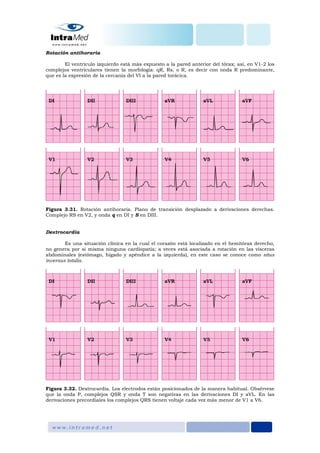 Rotación antihoraria
El ventrículo izquierdo está más expuesto a la pared anterior del tórax; así, en V1-2 los
complejos ventriculares tienen la morfología: qR, Rs, o R, es decir con onda R predominante,
que es la expresión de la cercanía del VI a la pared torácica.
Figura 3.31. Rotación antihoraria. Plano de transición desplazado a derivaciones derechas.
Complejo RS en V2, y onda q en DI y S en DIII.
Dextrocardia
Es una situación clínica en la cual el corazón está localizado en el hemitórax derecho,
no genera por si misma ninguna cardiopatía; a veces está asociada a rotación en las vísceras
abdominales (estómago, hígado y apéndice a la izquierda), en este caso se conoce como situs
inversus totalis.
Figura 3.32. Dextrocardia. Los electrodos están posicionados de la manera habitual. Obsérvese
que la onda P, complejos QSR y onda T son negativas en las derivaciones DI y aVL. En las
derivaciones precordiales los complejos QRS tienen voltaje cada vez más menor de V1 a V6.
 