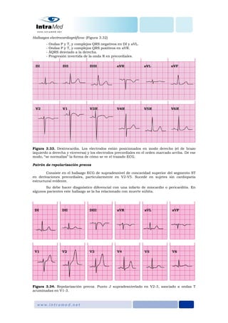 Hallazgos electrocardiográficos: (Figura 3.32)
- Ondas P y T, y complejos QRS negativos en DI y aVL.
- Ondas P y T, y complejos QRS positivos en aVR.
- ÂQRS desviado a la derecha.
- Progresión invertida de la onda R en precordiales.
Figura 3.33. Dextrocardia. Los electrodos están posicionados en modo derecho (el de brazo
izquierdo a derecha y viceversa) y los electrodos precordiales en el orden marcado arriba. De ese
modo, “se normaliza” la forma de cómo se ve el trazado ECG.
Patrón de repolarización precoz
Consiste en el hallazgo ECG de supradesnivel de concavidad superior del segmento ST
en derivaciones precordiales, particularmente en V2-V5. Sucede en sujetes sin cardiopatía
estructural evidente.
Su debe hacer diagnóstico diferencial con una infarto de miocardio o pericarditis. En
algunos pacientes este hallazgo se la ha relacionado con muerte súbita.
Figura 3.34. Repolarización precoz. Punto J supradesnivelado en V2-3, asociado a ondas T
acuminadas en V1-3.
 