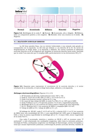 Figura 4.2. Morfologías de la onda P. A) Normal. B) Acuminada, alta y delgada. C) Bifásica,
tiene un componente positivo y otro negativo. D) Bimodal, tiene una muesca en el medio. D)
Negativa.
4.1. DILATACIÓN AURICULAR DERECHA
La AD tiene paredes finas, con su interior trabeculado y una orejuela más grande en
comparación con la izquierda. La AD está por delante y a la derecha de la AI. Su vector de
despolarización se dirige abajo, a la izquierda y adelante. En ciertas ocasiones la dilatación
auricular derecha es de tal magnitud que desplaza al ventrículo derecho hacia atrás, haciendo
que la onda P sea más alta que el complejo QRS, particularmente en las derivaciones DII y V1.
Figura 4.3. Esquema para representar el crecimiento de la aurícula derecha y el vector
resultante de su activación, el cual se dirige hacia abajo, adelante y a la izquierda.
Hallazgos electrocardiográficos: (Figuras 4.4 y 4.5)
1. ÂP desviado a la derecha, habitualmente entre +60º y +90.
2. Onda P: >0,25 mV en DII, DIII y/o aVF, y >0,15 mV en V1-2.
3. Onda P de duración normal, menos de 0.11 seg.
4. En casos de bajo voltaje del QRS, la onda P en DII y V1 es >50% que el QRS.
5. Onda P bifásica en V1 y V2 (porción positiva >0,15 mV y negatividad pequeña).
6. Morfología qR en V1 (en ausencia de infarto septal o bloqueo de rama izquierda).
7. En V1: Relación R/S >1 (en ausencia de BRD), y complejos QRS <0,4 mV.
8. Voltaje de QRS en V2 / voltaje de QRS en V1: > 5.
El hallazgo de: ÂP>90°, onda P >0,15 mV en V2, y relación R/S >1 en V1 (en ausencia
de BRD) tiene una sensibilidad del 49%, y una especificidad del 100% para el diagnóstico de
DAD, y tiene la misma especificidad la morfología qR en V1. A mayor DAD, menor negatividad
de la onda P de V1.
Una onda P acuminada, simétrica y positiva en DII-III y aVF se reconoce como “P
pulmonale”, y está relacionada con cardiopatía congénitas, tales como la estenosis pulmonar,
tetralogía de Fallot, cardiopatías congénitas con fisiología de Eisenmenger, atresia tricuspídea, y
otras que causan hipertensión pulmonar y sobrecarga de presión auricular derecha; también se
 