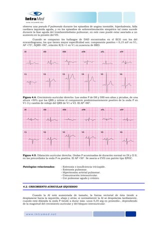 observa una pseudo P pulmonale durante los episodios de angina inestable, hiperkalemia, falla
cardiaca izquierda aguda, y en los episodios de sobreestimulación simpática tal como sucede
durante la fase aguda del tromboembolismo pulmonar, en este caso puede estar asociada a un
aumento en la presión del VD.
Cuando se comparan los hallazgos de DAD encontrados en el ECG con los del
ecocardiograma, los que tienen mayor especificidad son: componente positivo > 0,15 mV en V1,
AP >75°, ÂQRS >90°, relación R/S >1 en V1 en ausencia de BRD.
Figura 4.4. Crecimiento auricular derecho. Las ondas P de DII y DIII son altas y picudas, de una
altura >50% que los QRS y nótese el componente predominantemente positivo de la onda P en
V1-3 y cambio de voltaje del QRS de V1 a V2. El AP +80°.
Figura 4.5. Dilatación auricular derecha. Ondas P acuminadas de duración normal en DI y D II,
en las precordiales la onda P es positiva. El AP +50°. Se asocia a CVD con patrón tipo EPOC.
Patologías relacionadas: - Estenosis o insuficiencia tricúspide.
- Estenosis pulmonar.
- Hipertensión arterial pulmonar.
- Comunicación interauricular.
- Cor pulmonar agudo y crónico.
4.2. CRECIMIENTO AURICULAR IZQUIERDO
Cuando la AI está aumentada de tamaño, la fuerza vectorial de ésta tiende a
desplazarse hacia la izquierda, abajo y atrás; si normalmente la AI se despolariza tardíamente,
cuando está dilatada la onda P tiende a durar más -unos 0,35 seg en promedio-, dependiendo
de la magnitud del crecimiento auricular y del bloqueo interauricular.
 