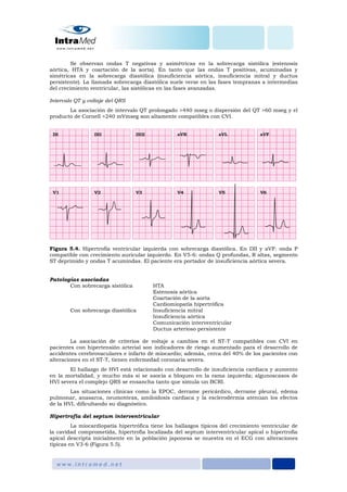 Se observan ondas T negativas y asimétricas en la sobrecarga sistólica (estenosis
aórtica, HTA y coartación de la aorta). En tanto que las ondas T positivas, acuminadas y
simétricas en la sobrecarga diastólica (insuficiencia aórtica, insuficiencia mitral y ductus
persistente). La llamada sobrecarga diastólica suele verse en las fases tempranas a intermedias
del crecimiento ventricular, las sistólicas en las fases avanzadas.
Intervalo QT y voltaje del QRS
La asociación de intervalo QT prolongado >440 mseg o dispersión del QT >60 mseg y el
producto de Cornell >240 mVmseg son altamente compatibles con CVI.
Figura 5.4. Hipertrofia ventricular izquierda con sobrecarga diastólica. En DII y aVF: onda P
compatible con crecimiento auricular izquierdo. En V5-6: ondas Q profundas, R altas, segmento
ST deprimido y ondas T acumindas. El paciente era portador de insuficiencia aórtica severa.
Patologías asociadas
Con sobrecarga sistólica HTA
Estenosis aórtica
Coartación de la aorta
Cardiomiopatía hipertrófica
Con sobrecarga diastólica Insuficiencia mitral
Insuficiencia aórtica
Comunicación interventricular
Ductus arterioso persistente
La asociación de criterios de voltaje a cambios en el ST-T compatibles con CVI en
pacientes con hipertensión arterial son indicadores de riesgo aumentado para el desarrollo de
accidentes cerebrovaculares e infarto de miocardio; además, cerca del 40% de los pacientes con
alteraciones en el ST-T, tienen enfermedad coronaria severa.
El hallazgo de HVI está relacionado con desarrollo de insuficiencia cardiaca y aumento
en la mortalidad, y mucho más si se asocia a bloqueo en la rama izquierda; algunoscasos de
HVI severa el complejo QRS se ensancha tanto que simula un BCRI.
Las situaciones clínicas como la EPOC, derrame pericárdico, derrame pleural, edema
pulmonar, anasarca, neumotórax, amiloidosis cardiaca y la esclerodermia atenúan los efectos
de la HVI, dificultando su diagnóstico.
Hipertrofia del septum interventricular
La miocardiopatía hipertrófica tiene los hallazgos típicos del crecimiento ventricular de
la cavidad comprometida, hipertrofia localizada del septum interventricular apical o hipertrofia
apical descripta inicialmente en la población japonesa se muestra en el ECG con alteraciones
típicas en V3-6 (Figura 5.5).
 