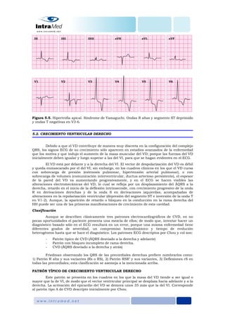 Figura 5.5. Hipertrofia apical. Síndrome de Yamaguchi. Ondas R altas y segmento ST deprimido
y ondas T negativas en V3-6.
5.2. CRECIMIENTO VENTRICULAR DERECHO
Debido a que el VD contribuye de manera muy discreta en la configuración del complejo
QRS, los signos ECG de su crecimiento sólo aparecen en estadíos avanzados de la enfermedad
que los motiva y que indujo el aumento de la masa muscular del VD; porque las fuerzas del VD
inicialmente deben igualar y luego superar a las del VI, para que se hagan evidentes en el ECG.
El VD está por delante y a la derecha del VI. El vector de despolarización del VD es débil
y queda enmascarado por el del VI; sin embargo, en los cuadros clínicos en los que el VD cursa
con sobrecarga de presión (estenosis pulmonar, hipertensión arterial pulmonar), o con
sobrecarga de volumen (comunicación interventricular, ductus arterioso persistente), el espesor
de la pared del VD va aumentando progresivamente, y en el ECG se hacen visibles las
alteraciones electromecánicas del VD, lo cual se refleja por un desplazamiento del ÂQRS a la
derecha, retardo en el inicio de la deflexión intrinsecoide, con crecimiento progresivo de la onda
R en derivaciones derechas y de la onda S en derivaciones izquierdas, acompañadas de
alteraciones en la repolarización ventricular (depresión del segmento ST e inversión de la onda T
en V1-2). Aunque, la aparición de retardo o bloqueo en la conducción en la rama derecha del
HH puede ser una de las primeras manifestaciones de crecimiento de esta cavidad.
Clasificación
Aunque se describen clásicamente tres patrones electrocardiográficos de CVD, en no
pocas oportunidades el paciente presenta una mezcla de ellos; de modo que, intentar hacer un
diagnóstico basado sólo en el ECG resultará en un error, porque una misma enfermedad tiene
diferentes grados de severidad, un compromiso hemodinámico y tiempo de evolución
heterogéneos hasta que se hace el diagnóstico. Los patrones ECG descriptos por Chou y col son:
- Patrón típico de CVD (ÂQRS desviado a la derecha y adelante)
- Patrón con bloqueo incompleto de rama derecha.
- CVD (ÂQRS desviado a la derecha y atrás)
Friedman observando los QRS de las precordiales derechas prefiere nombrarlos como:
1) Patrón R alta y sus variantes (Rs o RS), 2) Patrón RSR’ y sus variantes, 3) Deflexiones rS en
todas las precordiales; esta clasificación se asemeja a la mencionada arriba.
PATRÓN TÍPICO DE CRECIMIENTO VENTRICULAR DERECHO
Este patrón se presenta en los cuadros en los que la masa del VD tiende a ser igual o
mayor que la de VI, de modo que el vector ventricular principal se desplaza hacia adelante y a la
derecha. La activación del epicardio del VD se demora unos 35 más que la del VI. Corresponde
al patrón tipo A de CVD descripto inicialmente por Chou.
 
