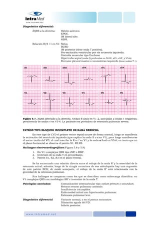 Diagnóstico diferencial:
ÂQRS a la derecha: Hábito asténico.
EPOC.
IM lateral alto.
HBPI.
Relación R/S >1 en V1: Niños
BCRD
IM posterior (tiene onda T positiva).
Pre-excitación ventricular por vía accesoria izquierda.
Distrofia muscular tipo Duchene
Hipertrofia septal (onda Q profundas en DI-III, aVL, aVF, y V5-6).
Derrame pleural masivo o neumotórax izquierdo (tiene ondas T +).
Figura 5.7. AQRS desviado a la derecha. Ondas R altas en V1-2, asociadas a ondas T negativas;
persistencia de ondas s en V5-6. La paciente era portadora de estenosis pulmonar severa.
PATRÓN TIPO BLOQUEO INCOMPLETO DE RAMA DERECHA
En este tipo de CVD el primer vector septal ocurre de forma normal, luego se manifiesta
la activación del ventrículo izquierdo (que explica la onda S o s en V1), para luego manifestarse
el vector tardío del VD, el cual inscribe la R o r’ en V1 y la onda s final en V5-6; en tanto que en
el plano horizontal se observa el patrón S1, R2,R3.
Hallazgos electrocardiográficos (Figura 5.8 y 5.9)
1. En V1: complejos QRS tipo rSR’ o RSR’.
2. Inversión de la onda T en precordiales.
3. Patrón S1, R2, R3 en el plano frontal.
Se ha encontrado una relación directa entre el voltaje de la onda R’ y la severidad de la
estenosis mitral; además, luego de la cirugía correctora de esa valvulopatía hay una regresión
de este patrón ECG; de modo semejante, el voltaje de la onda R’ está relacionada con la
gravedad de la estenosis pulmonar.
Sus hallazgos se comparan como los que se describen como sobrecarga diastólica: en
V1 complejos QRS con morfología rSR’ e inversión de la onda T.
Patologías asociadas: Comunicación interauricular tipo ostium primum o secundum.
Retorno venoso pulmonar anómalo.
Insuficiencia tricuspídea.
Enfermedad mitral con hipertensión pulmonar.
Estenosis pulmonar leve.
Diagnóstico diferencial Variante normal, o en el pectus excavatum.
Dilatación aguda del VD.
Infarto posterior.
 