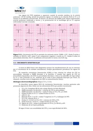 Los signos de CVD empiezan a aparecen cuando la presión sistólica en la arteria
pulmonar >35-40 mmHg, siendo los primeros signos: el cambio en la relación R/S en V1 y el
retraso en la deflexión intrinsecoide. El desvío a la derecha del ÂQRS suele indicar hipertensión
arterial pulmonar moderada a severa, y la presentación de la morfología qR en V1 expresa
enfermedad vascular avanzada.
Figura 5.11. Crecimiento del VD en portador de estenosis mitral. ÂQRS +125°. Onda P ancha y
mellada en DII-III y aVF, onda P con componente negativo y ancho en V1. Ondas R altas en
precordiales derechas. En V1 la deflexión intrinsecoide se inicia a los 0,05 seg.
5.3. CRECIMIENTO BIVENTRICULAR
A veces es difícil hacer este diagnóstico porque las manifestaciones de una se atenúan
por el crecimiento de la cavidad contralateral, aunque generalmente prevalecen los signos de
CVI.
Se sospecha crecimiento biventricular (CBV)) si hay criterios de voltaje de CVI en
precordiales, asociada a ÂQRS desviado a la derecha; o cuando hay signos de CVI en
precordiales izquierdas y de CVD en precordiales derechas, o bien si la onda S es de bajo voltaje
en V1 y más profunda en V2, síndrome de la onda S poco profunda descripto por Scott; no
obstante, muchas veces el diagnóstico de CBV es eminentemente clínico.
Hallazgos electrocardiográficos: (Figura 5.9. y 5.10.)
Se describen varios signos ECG de crecimiento biventricular, muchos pacientes sólo
presentan algunos de ellos. Estas son las alteraciones ECG que pueden encontrarse:
1. V3 y V4: Complejos RS de alto voltaje (Patrón de Katz-Wachtel).
2. ÂQRS desviado a la derecha + criterios de CVI en precordiales.
3. ÂQRS desviado a la derecha + ondas R altas en V5 y V6, y/o DAD.
4. Ondas R altas en V1-2 + ondas R altas en V5-6.
5. aVR: R > Q.
6. Relación R/S <1 en V5 + ondas T negativas en V1 y hallazgos de HVI.
7. V5 ó V6: relación R/S <1.
8. Ondas S > 0,7mV en V5 y V6 + criterios de CVD y CVI.
9. Onda S de V2 > S de V1 + ondas R altas en V5 y V6.
10. Signos de CVD + ondas Q profundas en V5-6, y/o DII-III y aVF.
11. Síndrome de la S poco profunda.
El signo 8 tiene una sensibilidad del 25% y una especificidad del 86%.
 