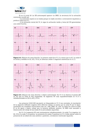 Si en el curso de un IM anteroseptal aparece un BRD, la secuencia de la activación
ventricular sucede así:
- La activación septal no se realiza porque es tejido necrótico o severamente isquémico y
produce onda Q en V1.
- A la activación inicial del VI, le sigue la activación tardía y lenta del VD generándose
una onda R ancha.
Figura 6.3. Bloqueo de rama derecha. La primera onda R en V1-2 y menor que su R’. La onda S
es ancha y mellada en DI, aVL, V5-6; se observan ondas T negativas asimétricas en V1-2.
Figura 6.4. Bloqueo de rama derecha e infarto anteroseptal. En V1-2 se observa el patrón QR
en las que la onda R está empastada. El segmento ST está supradesnivelado en V1-3 e
infradesnivelado en DI-II, aVF y V5-6.
Los primeros 0,06-0,08 seg (parte no bloqueada) en V1-2 son normales, la inscripción
de la siguiente deflexión negativa tiene diferente voltaje, lo mismo que la onda R’ que le sigue,
resultando así complejos ventriculares tipo rsr’, rSR’, RSR’, R, o Rs; en todos los casos la onda
R’ es de igual o mayor voltaje que la primera deflexión positiva. El BRD está asociado a
disminución del voltaje de las ondas R en precordiales izquierdas.
En V1-2 el segmento ST está minimamente infradesnivelado y la onda T es negativa; en
DI, V5-6, la onda T es positiva. La presencia de ondas T positivas en V1-2 debe alertar sobre la
presencia de un infarto de cara anterior o posterior, crecimiento ventricular izquierdo.
 