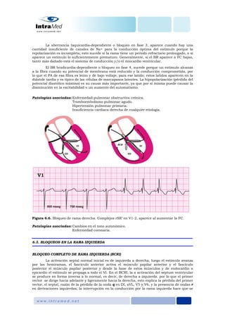 La aberrancia taquicardia-dependiente o bloqueo en fase 3, aparece cuando hay una
cantidad insuficiente de canales de Na+ para la conducción óptima del estímulo porque la
repolarización es incompleta; esto sucede si la rama tiene un periodo refractario prolongado, o si
aparece un estímulo lo suficientemente prematuro. Generalmente, si el BR aparece a FC bajas,
tanto más dañado está el sistema de conducción y/o el miocardio ventricular.
El BR bradicardia-dependiente o bloqueo en fase 4, sucede porque un estímulo alcanza
a la fibra cuando su potencial de membrana está reducido y la conducción comprometida, por
lo que el PA de esa fibra es lento y de bajo voltaje, para ese latido; estos latidos aparecen en la
diástole tardía y es típico de las células de marcapasos latentes. La hipopolarización (pérdida del
potencial diastólico máximo) es su causa más importante, ya que por sí misma puede causar la
disminución en la excitabilidad o un aumento del automatismo.
Patologías asociadas: Enfermedad pulmonar obstructiva crónica.
Tromboembolismo pulmonar agudo.
Hipertensión pulmonar primaria.
Insuficiencia cardiaca derecha de cualquier etiología.
Figura 6.6. Bloqueo de rama derecha. Complejos rSR’ en V1-2, aparece al aumentar la FC.
Patologías asociadas: Cambios en el tono autonómico.
Enfermedad coronaria.
6.3. BLOQUEOS EN LA RAMA IZQUIERDA
BLOQUEO COMPLETO DE RAMA IZQUIERDA (BCRI)
La activación septal normal inicial es de izquierda a derecha, luego el estímulo avanza
por las hemiramas, el fascículo anterior activa el músculo papilar anterior y el fascículo
posterior el músculo papilar posterior y desde la base de estos músculos y de endocardio a
epicardio el estímulo se propaga a todo el VI. En el BCRI, la a activación del septum ventricular
se produce en forma inversa a lo normal, es decir, de derecha a izquierda. por lo que el primer
vector se dirige hacia adelante y ligeramente hacia la derecha, esto explica la pérdida del primer
vector, el septal, razón de la pérdida de la onda q en DI, aVL, V5 y V6, y la presencia de ondas r
en derivaciones izquierdas; la interrupción en la conducción por la rama izquierda hace que se
 