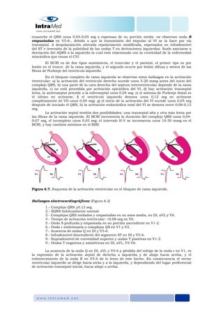 ensanche el QRS unos 0,04-0,05 seg a expensas de su porción media –se observan onda R
empastadas en V5-6-, debido a que la transmisión del impulso al VI se la hace por vía
transeptal. A despolarización alterada repolarización modificada, expresados en infradesnivel
del ST e inversión de la polaridad de las ondas T en derivaciones izquierdas. Suele asociarse a
desviación del AQRS a la izquierda la cual está relacionada con la cronicidad de la enfermedad
miocárdica que causa el CVI.
El BCRI es de dos tipos anatómicos, el troncular y el parietal, el primer tipo es por
lesión en el tronco de la rama izquierda, y el segundo ocurre por lesión difusa y severa de las
fibras de Purkinje del ventrículo izquierdo.
En el bloqueo completo de rama izquierda se observan estos hallazgos en la activación
ventricular: a) la activación del ventrículo derecho sucede unos 5-20 mseg antes del inicio del
complejo QRS, b) una parte de la cara derecha del septum interventricular depende de la rama
izquierda, c) no está precedida por activación epicárdica del VI, d) hay activación transeptal
lenta, la anteroseptal precede a la inferoseptal unos 0,04 seg. e) el sistema de Purkinje distal es
el último en activarse, f) el ventrículo izquierdo demora unos 0,12 seg en activarse
completamente (el VD unos 0,04 seg). g) el inicio de la activación del VI sucede unos 0,05 seg
después de iniciado el QRS, h) la activación endocárdica total del VI se demora entre 0,06-0,12
seg.
La activación septal tendría dos posibilidades: una transeptal alta y otra más lenta por
las fibras de la rama izquierda. El BCRI incrementa la duración del complejo QRS unos 0,04-
0,07 seg, el incompleto unos 0,03 seg; el intervalo H-V se incrementa unos 10-30 mseg en el
BCRI, y hay cambios mínimos en el BIRI.
Figura 6.7. Esquema de la activación ventricular en el bloqueo de rama izquierda.
Hallazgos electrocardiográficos: (Figura 6.2)
1.- Complejo QRS >0,12 seg.
2.- ÂQRS habitualmente normal.
3.- Complejos QRS mellados y empastadas en su zona media, en DI, aVL y V6.
4.- Tiempo de activación ventricular: >0,08 seg en V6.
5.- Onda S profunda y empastada en su porción ascendente en V1-2.
6.- Onda r embrionaria o complejos QS en V1 y V2.
7.- Ausencia de ondas Q en DI y V5-6.
8.- Infradesnivel descendente del segmento ST en DI y V5-6.
9.- Supradesnivel de convexidad superior y ondas T positivas en V1-2.
9.- Ondas T negativas y asimétricas en DI, aVL, V5-V6.
La ausencia de la onda Q en DI, aVL y V5-6 y pérdida del voltaje de la onda r en V1, es
la expresión de la activación septal de derecha a izquierda y de abajo hacia arriba, y el
enlentecimiento de la onda R en V5-6 de lo lento de este hecho. En consecuencia el vector
ventricular izquierdo se dirige hacia atrás y a la izquierda, y dependiendo del lugar preferencial
de activación transeptal inicial, hacia abajo o arriba.
 