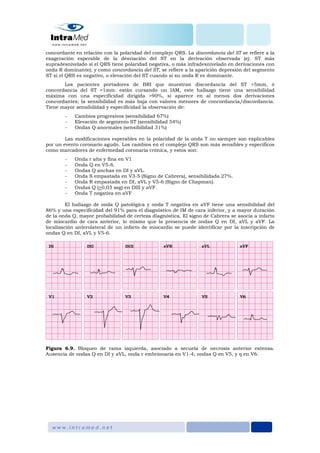 concordante en relación con la polaridad del complejo QRS. La discordancia del ST se refiere a la
exageración esperable de la desviación del ST en la derivación observada (ej: ST más
supradesnivelado si el QRS tiene polaridad negativa, o más infradesnivelado en derivaciones con
onda R dominante); y como concordancia del ST, se refiere a la aparición depresión del segmento
ST si el QRS es negativo, o elevación del ST cuando si su onda R es dominante.
Los pacientes portadores de BRI que muestran discordancia del ST >5mm, ó
concordancia del ST >1mm: están cursando un IAM, este hallazgo tiene una sensibilidad
máxima con una especificidad dirigida >90%, si aparece en al menos dos derivaciones
concordantes; la sensibilidad es más baja con valores menores de concordancia/discordancia.
Tiene mayor sensibilidad y especificidad la observación de:
- Cambios progresivos (sensibilidad 67%)
- Elevación de segmento ST (sensibilidad 54%)
- Ondas Q anormales (sensibilidad 31%)
Las modificaciones esperables en la polaridad de la onda T no siempre son explicables
por un evento coronario agudo. Los cambios en el complejo QRS son más sensibles y específicos
como marcadores de enfermedad coronaria crónica, y estos son:
- Onda r alta y fina en V1
- Onda Q en V5-6.
- Ondas Q anchas en DI y aVL.
- Onda S empastada en V3-5 (Signo de Cabrera), sensibilidada 27%.
- Onda R empastada en DI, aVL y V5-6 (Signo de Chapman).
- Ondas Q (>0,03 seg) en DIII y aVF.
- Onda T negativa en aVF
El hallazgo de onda Q patológica y onda T negativa en aVF tiene una sensibilidad del
86% y una especificidad del 91% para el diagnóstico de IM de cara inferior, y a mayor duración
de la onda Q, mayor probabilidad de certeza diagnóstica. El signo de Cabrera se asocia a infarto
de miocardio de cara anterior, lo mismo que la presencia de ondas Q en DI, aVL y aVF. La
localización anterolateral de un infarto de miocardio se puede identificar por la inscripción de
ondas Q en DI, aVL y V5-6.
Figura 6.9. Bloqueo de rama izquierda, asociado a secuela de necrosis anterior extensa.
Ausencia de ondas Q en DI y aVL, onda r embrionaria en V1-4, ondas Q en V5, y q en V6.
 