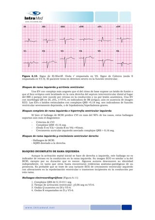 Figura 6.10. Signo de El-Sheriff. Onda r’ empastada en V6. Signo de Cabrera (onda S
empastada en V3-5). El paciente tenía en deterioro severo en la función ventricular.
Bloqueo de rama izquierda y arritmia ventricular
Una EV con complejo más angosto que el del ritmo de base supone un latido de fusión o
que el foco ectópico está localizado en la cara derecha del septum interventricular distal al lugar
del BRI o porque éste sucede por retraso en la conducción y no por lesión anatómica. Una EV
con morfología QR en DI, aVL, ó V5-6, es indicadora de IM antiguo, aún en ausencia de imagen
ECG. Las EVs o latidos estimulados con complejos QRS >0,18 seg. son indicadoras de función
ventricular severamente deprimida, o de hipokalemia/hiperkalemia graves.
Bloqueo completo de rama izquierda e hipertrofia ventricular izquierda
SI bien el hallazgo de BCRI predice CVI en más del 90% de los casos, estos hallazgos
soportan aún más el diagnóstico:
- Criterios de CVI
- Complejos QSR >0,16 seg.
- (Onda S en V2) + (onda R en V6) >45mm.
- Crecimiento auricular izquierdo asociado complejos QRS > 0,16 seg.
Bloqueo de rama izquierda y crecimiento ventricular derecho
- Hallazgos de BCRI.
- ÂQRS desviado a la derecha.
BLOQUEO INCOMPLETO DE RAMA IZQUIERDA
Aunque la activación septal inicial se hace de derecha a izquierda, este hallazgo no es
indicador de retraso en la conducción en la rama izquierda. Su imagen ECG es similar a la del
BCRI, excepto por su duración que es menor. Algunos autores desconocen su identidad
independiente, en tanto que otros hasta encontraron evidencias anátomo-patológicas de su
presencia. Es probable que se trate de una variante ECG de crecimiento ventricular izquierdo
con alteraciones en la repolarización ventricular o trastornos incipientes en la conducción por
esta rama.
Hallazgos electrocardiográficos: (Figura 6.11)
1. Complejos QRS de 0,10-011 seg.
2. Tiempo de activación ventricular: >0,06 seg en V5-6.
3. Ondas Q ausentes en DI y V5-6.
4. Ondas R empastadas en D y V5-6.
 