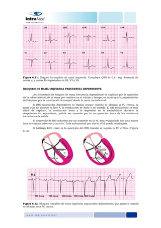 Figura 6.11. Bloqueo incompleto de rama izquierda. Complejos QRS de 0,11 seg. Ausencia de
ondas q, y ondas R empastadas en DI, V5 y V6.
BLOQUEO DE RAMA IZQUIERDA FRECUENCIA DEPENDIENTE
Los fenómenos de bloqueo de rama frecuencia dependiente se explican por la aparición
de la refractariedad de la rama por cambios en el voltaje y tiempo, en tanto que la perpetuación
del bloqueo, por la conducción transeptal desde la rama contralateral.
El BRI taquicardia dependiente se explica porque cuando se alcanza la FC crítica, la
rama aún no alcanzó la fase 4, la conducción es lenta o no sucede. El BR bradicardia es más
difícil de explicar, la conducción lenta y la depresión en la excitabilidad durante la
despolarización espontánea, podría ser causada por la recuperación lenta de las corrientes
transitorias de salida.
El desarrollo de BRI inducido por un aumento en la FC está relacionado con una mayor
tasa de eventos adversos y muerte. Toda enfermedad que afecte el VI puede ocasionarla.
El hallazgo ECG clave es la aparición del BRI cuando se supera la FC crítica, (Figura
6.12).
Figura 6.12. Bloqueo completo de rama izquierda taquicardia-dependiente, que aparece cuando
se alcanza una FC crítica.
 
