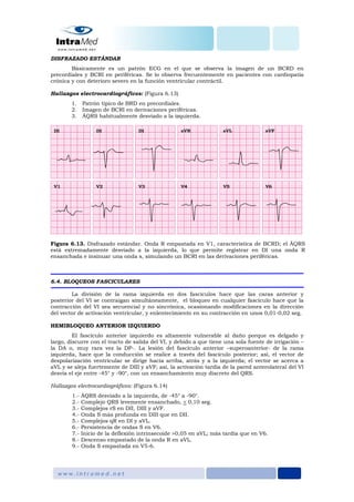 DISFRAZADO ESTÁNDAR
Básicamente es un patrón ECG en el que se observa la imagen de un BCRD en
precordiales y BCRI en periféricas. Se lo observa frecuentemente en pacientes con cardiopatía
crónica y con deterioro severo en la función ventricular contráctil.
Hallazgos electrocardiográficos: (Figura 6.13)
1. Patrón típico de BRD en precordiales.
2. Imagen de BCRI en derivaciones periféricas.
3. ÂQRS habitualmente desviado a la izquierda.
Figura 6.13. Disfrazado estándar. Onda R empastada en V1, característica de BCRD; el ÂQRS
está extremadamente desviado a la izquierda, lo que permite registrar en DI una onda R
ensanchada e insinuar una onda s, simulando un BCRI en las derivaciones periféricas.
6.4. BLOQUEOS FASCICULARES
La división de la rama izquierda en dos fascículos hace que las caras anterior y
posterior del VI se contraigan simultáneamente, el bloqueo en cualquier fascículo hace que la
contracción del VI sea secuencial y no sincrónica, ocasionando modificaciones en la dirección
del vector de activación ventricular, y enlentecimiento en su contracción en unos 0,01-0,02 seg.
HEMIBLOQUEO ANTERIOR IZQUIERDO
El fascículo anterior izquierdo es altamente vulnerable al daño porque es delgado y
largo, discurre con el tracto de salida del VI, y debido a que tiene una sola fuente de irrigación –
la DA o, muy rara vez la DP-. La lesión del fascículo anterior –superoanterior- de la rama
izquierda, hace que la conducción se realice a través del fascículo posterior; así, el vector de
despolarización ventricular se dirige hacia arriba, atrás y a la izquierda; el vector se acerca a
aVL y se aleja fuertemente de DIII y aVF; así, la activación tardía de la pared anterolateral del VI
desvía el eje entre -45° y -90°, con un ensanchamiento muy discreto del QRS.
Hallazgos electrocardiográficos: (Figura 6.14)
1.- ÂQRS desviado a la izquierda, de -45° a -90°.
2.- Complejo QRS levemente ensanchado, < 0,10 seg.
3.- Complejos rS en DII, DIII y aVF.
4.- Onda S más profunda en DIII que en DII.
5.- Complejos qR en DI y aVL.
6.- Persistencia de ondas S en V6.
7.- Inicio de la deflexión intrinsecoide >0,05 en aVL; más tardía que en V6.
8.- Descenso empastado de la onda R en aVL.
9.- Onda S empastada en V5-6.
 
