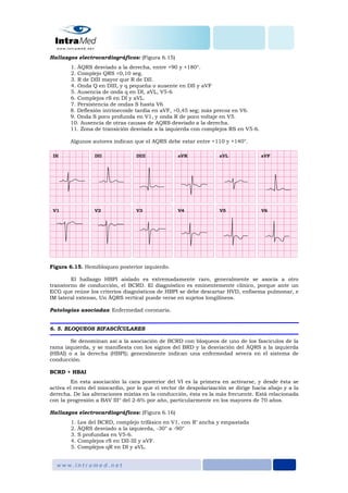 Hallazgos electrocardiográficos: (Figura 6.15)
1. ÂQRS desviado a la derecha, entre +90 y +180°.
2. Complejo QRS <0,10 seg.
3. R de DIII mayor que R de DII.
4. Onda Q en DIII, y q pequeña o ausente en DII y aVF
5. Ausencia de onda q en DI, aVL, V5-6
6. Complejos rS en DI y aVL.
7. Persistencia de ondas S hasta V6
8. Deflexión intrinecoide tardía en aVF, >0,45 seg; más precoz en V6.
9. Onda S poco profunda en V1, y onda R de poco voltaje en V5.
10. Ausencia de otras causas de AQRS desviado a la derecha.
11. Zona de transición desviada a la izquierda con complejos RS en V5-6.
Algunos autores indican que el AQRS debe estar entre +110 y +140°.
Figura 6.15. Hemibloqueo posterior izquierdo.
El hallazgo HBPI aislado es extremadamente raro, generalmente se asocia a otro
transtorno de conducción, el BCRD. El diagnóstico es eminentemente clínico, porque ante un
ECG que reúne los criterios diagnósticos de HBPI se debe descartar HVD, enfisema pulmonar, e
IM lateral extenso, Un ÂQRS vertical puede verse en sujetos longilíneos.
Patologías asociadas: Enfermedad coronaria.
6. 5. BLOQUEOS BIFASCÍCULARES
Se denominan así a la asociación de BCRD con bloqueos de uno de los fascículos de la
rama izquierda, y se manifiesta con los signos del BRD y la desviación del ÂQRS a la izquierda
(HBAI) o a la derecha (HBPI); generalmente indican una enfermedad severa en el sistema de
conducción.
BCRD + HBAI
En esta asociación la cara posterior del VI es la primera en activarse, y desde ésta se
activa el resto del miocardio, por lo que el vector de despolarización se dirige hacia abajo y a la
derecha. De las alteraciones mixtas en la conducción, ésta es la más frecuente. Está relacionada
con la progresión a BAV III° del 2-6% por año, particularmente en los mayores de 70 años.
Hallazgos electrocardiográficos: (Figura 6.16)
1. Los del BCRD, complejo trifásico en V1, con R’ ancha y empastada
2. ÂQRS desviado a la izquierda, -30° a -90°
3. S profundas en V5-6.
4. Complejos rS en DII-III y aVF.
5. Complejos qR en DI y aVL.
 