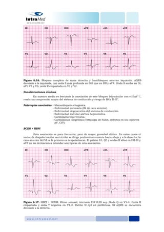 Figura 6.16. Bloqueo completo de rama derecha y hemibloqueo anterior izquierdo. ÂQRS
desviado a la izquierda, con onda S más profunda en DIII que en DII y aVF. Onda S ancha en DI,
aVL V5 y V6; onda R empastada en V1 y V2.
Consideraciones clínicas
En nuestro medio es frecuente la asociación de este bloqueo bifascicular con el BAV I°,
revela un compromiso mayor del sistema de conducción y riesgo de BAV II-III°.
Patologías asociadas: - Miocardiopatía chagásica.
- Enfermedad coronaria (IM de cara anterior).
- Enfermedad degenerativa del sistema de conducción.
- Enfermedad valvular aórtica degenerativa.
- Cardiopatía hipertensiva.
- Cardiopatías congénitas (Tetralogía de Fallot, defectos en los cojinetes
AV, CIV).
BCDR + HBPI
Esta asociación es poco frecuente, pero de mayor gravedad clínica. En estos casos el
vector de despolarización ventricular se dirige predominantemente hacia abajo y a la derecha, la
cara anterior del VI es la primera es despolarizarse. El patrón S1, Q3 y ondas R altas en DII-III y
aVF en las derivaciones estándar son típicas de esta asociación.
Figura 6.17. HBPI + BCDR. Ritmo sinusal, intervalo P-R 0,20 seg. Onda Q en V1-4. Onda R
empastada y onda T negativa en V1-2. Patrón S1,Q3 en periféricas. El ÂQRS se encuentra
desviado a la derecha.
 