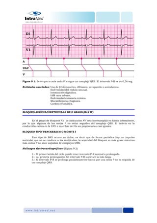 Figura 9.1. Se ve que a cada onda P le sigue un complejo QRS. El intervalo P-R es de 0,26 seg.
Entidades asociadas: Uso de β-bloqueantes, diltiazem, verapamilo o amiodarona.
Enfermedad del nódulo sinusal.
Intoxicación digitálica.
IAM cara inferior.
Enfermedad coronaria crónica.
Miocardiopatía chagásica.
Carditis reumática.
BLOQUEO AURICULOVENTRICULAR DE II GRADO (BAV II°)
En el grupo de bloqueos AV la conducción AV está interrumpida en forma intermitente,
por lo que algunas de las ondas P no están seguidas del complejo QRS. El defecto en la
conducción radica en la UAV o en el haz de His en proporciones casi iguales.
BLOQUEO TIPO WENCKEBACH O MOBITZ I
Este tipo de BAV ocurre en ciclos, es decir que de forma periódica hay un impulso
auricular que no se conduce a los ventrículos, la severidad del bloqueo es más grave mientras
más ondas P no sean seguidas de complejos QRS.
Hallazgos electrocardiográficos: (Figura 9.2)
1.- El primer latido del ciclo puede tener intervalo P-R normal o prolongado.
2.- La primera prolongación del intervalo P-R suele ser la más larga.
3.- El intervalo P-R se prolonga paulatinamente hasta que una onda P no va seguida de
un complejo QRS.
 