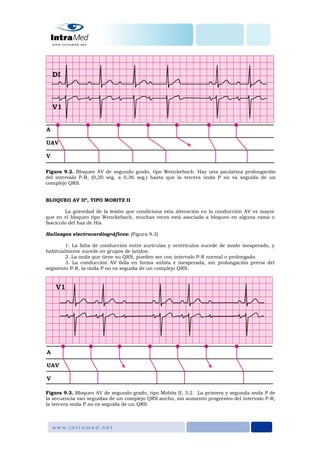 Figura 9.2. Bloqueo AV de segundo grado, tipo Wenckebach. Hay una paulatina prolongación
del intervalo P-R, (0,20 seg. a 0,36 seg.) hasta que la tercera onda P no va seguida de un
complejo QRS.
BLOQUEO AV IIº, TIPO MOBITZ II
La gravedad de la lesión que condiciona esta alteración en la conducción AV es mayor
que en el bloqueo tipo Wenckebach, muchas veces está asociada a bloqueo en alguna rama o
fascículo del haz de His.
Hallazgos electrocardiográficos: (Figura 9.3)
1. La falta de conducción entre aurículas y ventrículos sucede de modo inesperado, y
habitualmente sucede en grupos de latidos.
2. La onda que tiene su QRS, pueden ser con intervalo P-R normal o prolongado.
3. La conducción AV falla en forma súbita e inesperada, sin prolongación previa del
segmento P-R, la onda P no va seguida de un complejo QRS.
Figura 9.3. Bloqueo AV de segundo grado, tipo Mobitz II, 3:2. La primera y segunda onda P de
la secuencia van seguidas de un complejo QRS ancho, sin aumento progresivo del intervalo P-R;
la tercera onda P no es seguida de un QRS.
 