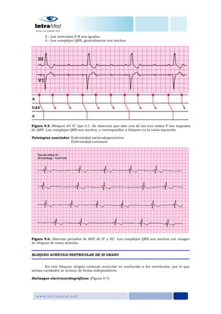 3.- Los intervalos P-R son iguales.
4.- Los complejos QRS, generalmente son anchos.
Figura 9.5. Bloqueo AV II° tipo 3:1. Se observan que sólo una de las tres ondas P van seguidas
de QRS. Los complejos QRS son anchos, y corresponden a bloqueo en la rama izquierda.
Patologías asociadas Enfermedad esclerodegenerativa
Enfermedad coronaria
Figura 9.6. Alternan periodos de BAV de II° y III°. Los complejos QRS son anchos con imagen
de bloqueo de rama derecha.
BLOQUEO AURÍCULO-VENTRICULAR DE III GRADO
En este bloqueo ningún estímulo auricular es conducido a los ventrículos, por lo que
ambas cavidades se activan de forma independiente.
Hallazgos electrocardiográficos: (Figura 9.7)
 