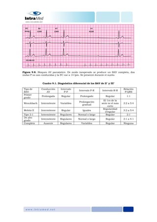 Figura 9.8. Bloqueo AV paroxístico. De modo inesperado se produce un BAV completo, dos
ondas P no son conducidas y la FC cae a 14 lpm. Se presentó durante el sueño.
Cuadro 9.1. Diagnóstico diferencial de los BAV de II° y III°
Tipo de
BAV
Conducción
AV
Intervalo
P-P
Intervalo P-R Intervalo R-R
Relación
P:QRS
Primer
grado
Prolongada Regular Prolongado Regular 1:1
Wenckbach Intermitente Variables
Prolongación
gradual
El 1ro de la
serie es el más
corto
3:2 a 5:4
Mobitz II Intermitente Regular Iguales
Regularidad
irregular
3:2 a 5:4
Tipo 2:1 Intermitente Regulares Normal o largo Regular 2:1
De alto
grado
Intermitente Regulares Normal o largo Regular 3:1 a 4:1
Completo Ausente Regulares Variables Regular Ninguna
 