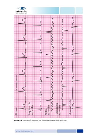 Figura 9.9. Bloqueo AV completo con diferentes tipos de ritmo auricular.
 