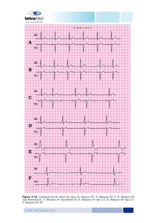 Figura 9.10. Comparación de todos los tipos de bloqueo AV. A. Bloqueo AV I°, B. Bloqueo AV
tipo Wenkebach. C. Bloqueo AV tipo Mobitz II. D. Bloqueo AV tipo 2:1. E. Bloqueo AV tipo 3:1.
F. Bloqueo AV III°.
 