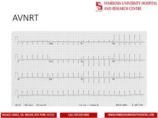 ecg interpretation ..learning Electrocardiogram.pptx