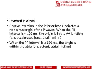 Partially Inverted P Wave ecg interpretation ..learning Electrocardiogram.pptx