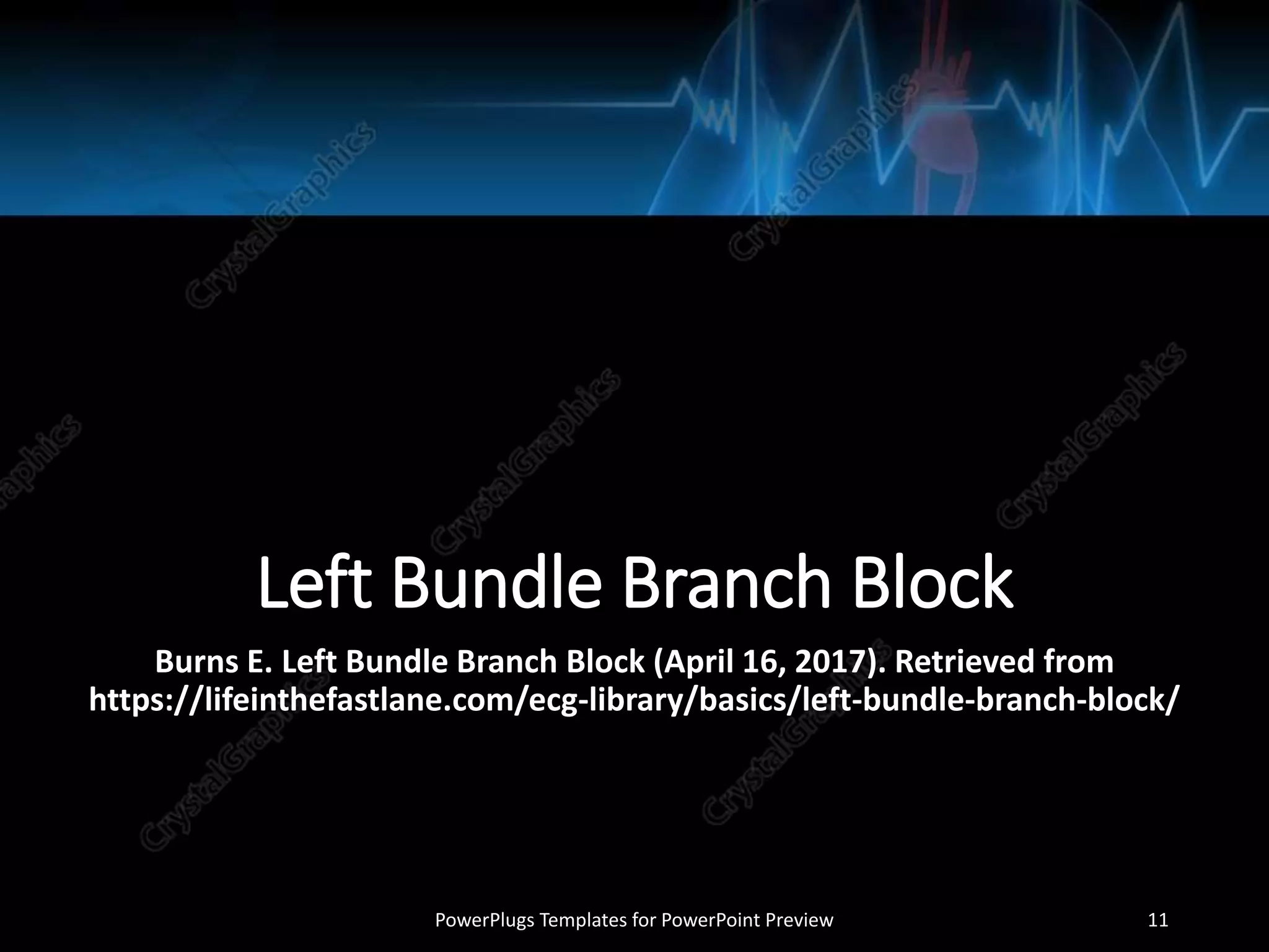 Left Bundle Branch Block
Burns E. Left Bundle Branch Block (April 16, 2017). Retrieved from
https://lifeinthefastlane.com/ecg-library/basics/left-bundle-branch-block/
PowerPlugs Templates for PowerPoint Preview 11
 
