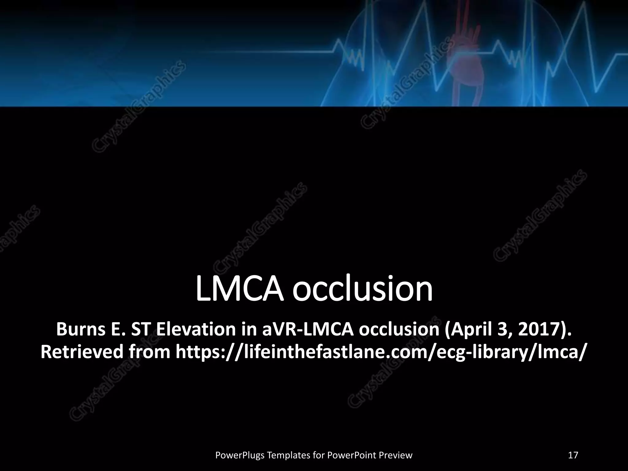 LMCA occlusion
Burns E. ST Elevation in aVR-LMCA occlusion (April 3, 2017).
Retrieved from https://lifeinthefastlane.com/ecg-library/lmca/
PowerPlugs Templates for PowerPoint Preview 17
 