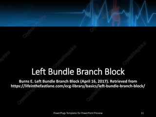 Left Bundle Branch Block
Burns E. Left Bundle Branch Block (April 16, 2017). Retrieved from
https://lifeinthefastlane.com/ecg-library/basics/left-bundle-branch-block/
PowerPlugs Templates for PowerPoint Preview 11
 